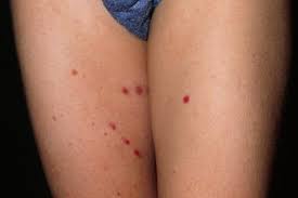 Scurvy is a disease caused by vitamin c deficiency. Henoch Schonlein Purpura Hsp Nhs