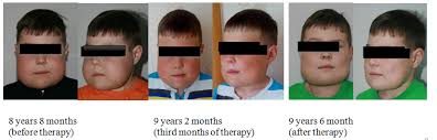 Cherubism has historically been considered a variant of fibrous dysplasia, but in reality is likely a distinct entity. Cherubism In 8 Years Old Child Treatment Experience Medcrave Online