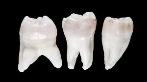 (photo of 5 year old) six years: 9 Important Facts About Wisdom Teeth And Tooth Removal Webdento