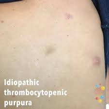 Senile purpura is benign, easy bruising that affects older adults. Idiopathic Thrombocytopenic Purpura Skin Deep