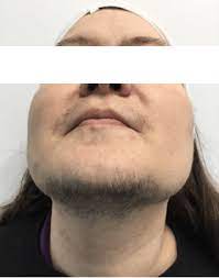 Treating your pcos can help get rid of excess facial hair, dr. Laser Hair Removal For Polycystic Ovary Syndrome The Cosmetic Clinic