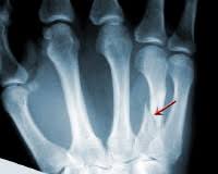 What is a stress fracture? Broken Finger
