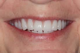 Image result for dentures