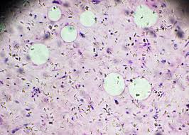 În gramatica tradițională, partea de vorbire este o clasă de cuvinte stabilită după sensul lor lexical general și după caracteristicile lor morfologice și sintactice. Liposarcoma Que Es Aecc