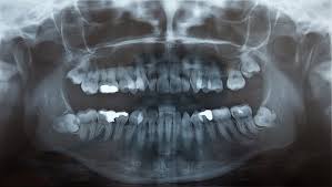 Smoking will delay the healing process and increase the. Time For Wisdom Teeth Removal Perth Professional Dentists Advice