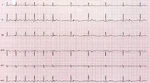 Image result for Atrioventricular Block