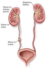 Kidney Stones Treatment Melbourne North Eastern Urology