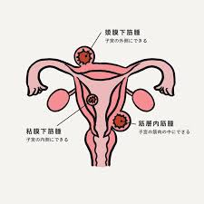 子宮 筋腫 変性 痛