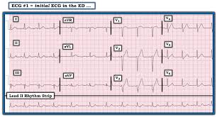 1 among these, dwp is characterized by loss of r waves in the precordial leads. Ecg Interpretation Ecg Blog 183 Ecg Mp 1 Repolarization Variant Hyperacute Dewinter