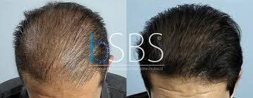 Scopri come funziona un trapianto di capelli senza cicatrici e rasatura. Calvizie Il Trapianto Di Capelli Non E La Cura Tgcom24
