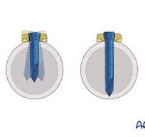 Locking head screw insertion