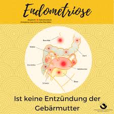 Bei der endometriose erscheint und wächst die gebärmutterschleimhaut, die das innere der gebärmutter bedeckt, an anderen stellen außerhalb der. Endometriose Bonn Was Ist Endometriose
