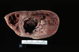 Check spelling or type a new query. File Ami Mural Thrombus 1 Jpg Wikidoc