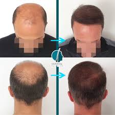 We did not find results for: Grade 7 8 Hair Loss Maral Hair