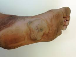 Two of the most common foot fungi infections are tinea pedis. Webpathology Com A Collection Of Surgical Pathology Images