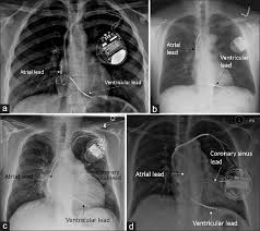Browse 83 pacemaker xray stock photos and images available, or start a new search to explore more stock photos and images. Anaesthetic Consideration In Patients With Cardiac Implantable Electronic Devices Scheduled For Surgery Chakravarthy M Prabhakumar D George A Indian J Anaesth