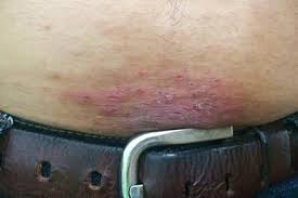 Image result for Contact Dermatitis