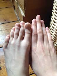 Image result for foot fingers