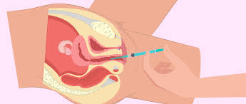 Depuis que vous êtes en âge d'avoir des relations sexuelles, vous avez une épée de damoclès au dessus de la tête. Insemination Artisanale Definition Mode D Emploi Et Taux De Reussite
