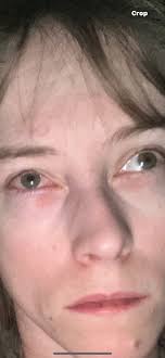 I have glaucoma. Can't even 👀 that far.