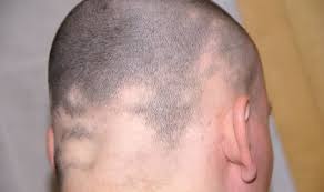 Hay ic, jamieson m, ormerod ad. Kreisrunder Haarausfall Alopecia Areata Netdoktor At