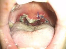 Das gilt in einem alter von fünf bis 15 jahren. Mandel Op Die Genesung Gesundheit Medizin Operation