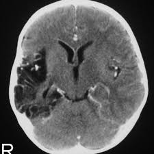 The peak incidence of herpes simplex encephalitis (hse) occurs in very young children and adults over the age of 50 years with both sexes equally affected and have an. Herpes Simplex Type 1 Encephalitis Eurorad