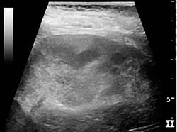 Image result for Acute Pyelonephritis