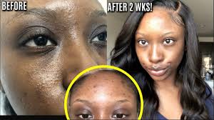 Earn 5% rewards on every order. How To Get Rid Of Acne Scars Pimples Blemishes Fast 100 Results Skincare Routine Youtube
