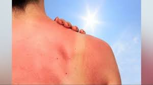 Image result for Sun Exposure