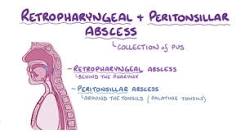 Image result for icd 10 code for tonsil abscess