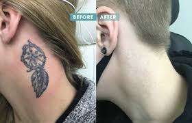 The kind of ink used is also a major factor. Results Of Laser Tattoo Removal Removery