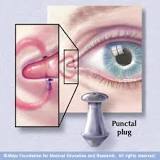 Image result for how often are punctal plugs covered by medicare