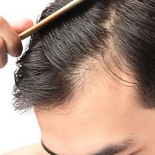 Obbialero fabrizio, l'auto trapianto di capelli a torino con tecnica fue ha un costo a partire da 2500€. Trapianto Capelli A Roseto Degli Abruzzi Con Tecnica Microfue Dr Donato Zizi