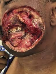 Mucormycosis refers to several different diseases caused by infection with fungi in the order of mucorales. Invasive Mucormycosis In A Renal Transplant Recipient Kidney International