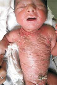 Image result for Ichthyosis