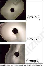 Endodontic post crown bridge restoration on abutment inlay onlay veneer, tabletop maryland and inlay/onlay bridge 1 priming not required for 3m™ relyx™ fiber posts | 2 alternative primer: Comparison Between Three Glass Fiber Post Cementation Techniques Semantic Scholar