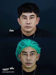 รีวิวโปรแกรม ULTHERA SPT ยกกระชับใบหน้าสำหรับคนวัย 30+