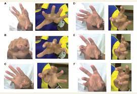 It is caused by fluid buildup in the baby, called hydrops. Pdf Congenital Mirror Movements Lack Of Decussation Of Pyramids Semantic Scholar
