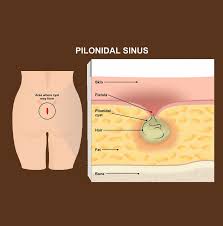 Image result for Pilonidal Cyst