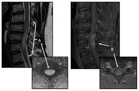 Image result for Myelitis