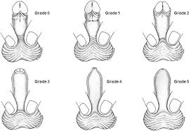 Image result for paraphimosis