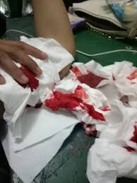 Bloody horror and halloween theme: Lepas Kb Implan Lengan Ibu Ini Malah Berdarah Dan Bengkak