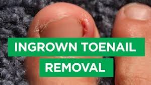 Image result for Toenail Removal
