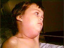 Mumps Wikipedia