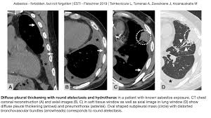 Pleural thickening is a disease that causes thickening of the lung lining, or pleura. Epos