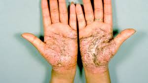 Image result for Pustular Psoriasis