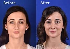 Even though insurance does not cover a rhinoplasty, the price can still be affordable. Rhinoplasty Ohsu