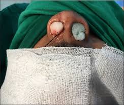 Image result for Nasal Packing