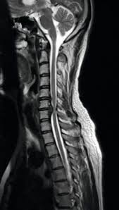 The disc often presses on a nerve root which can cause pain and other symptoms in a leg. Slip Disc Herniated Disc Ayurveda Panchakarma Therapy